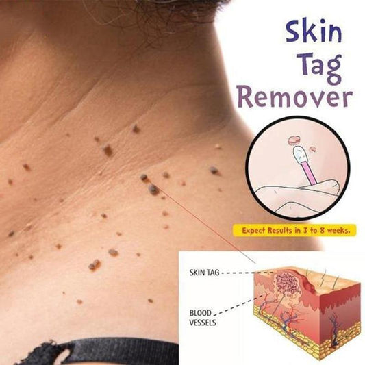 Skin Tag Remover Skin Care 1PC